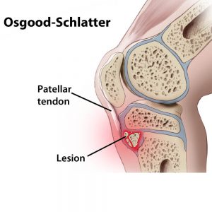 ant_Sindrome di Osghood Shlatter